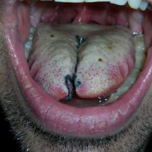 split tongue healing 2022
