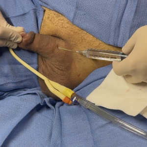 More Anesthetic Injections