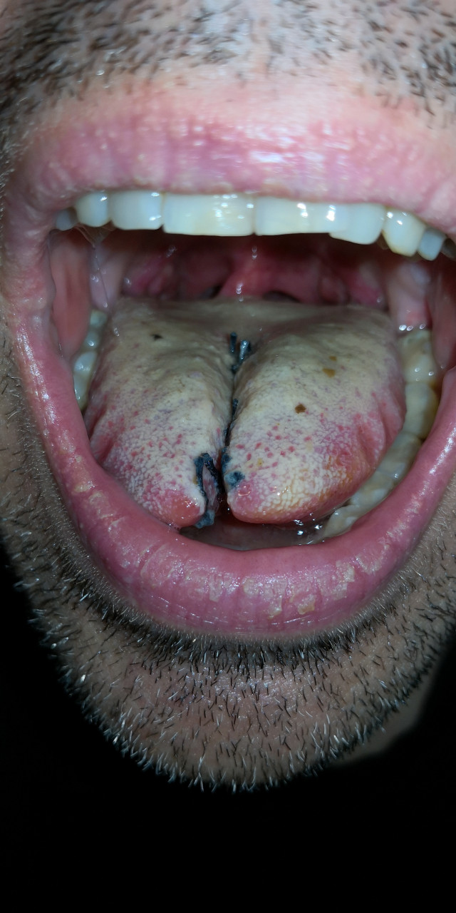split tongue healing 2022