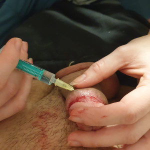 numbing