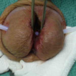 save the ampallang while splitting