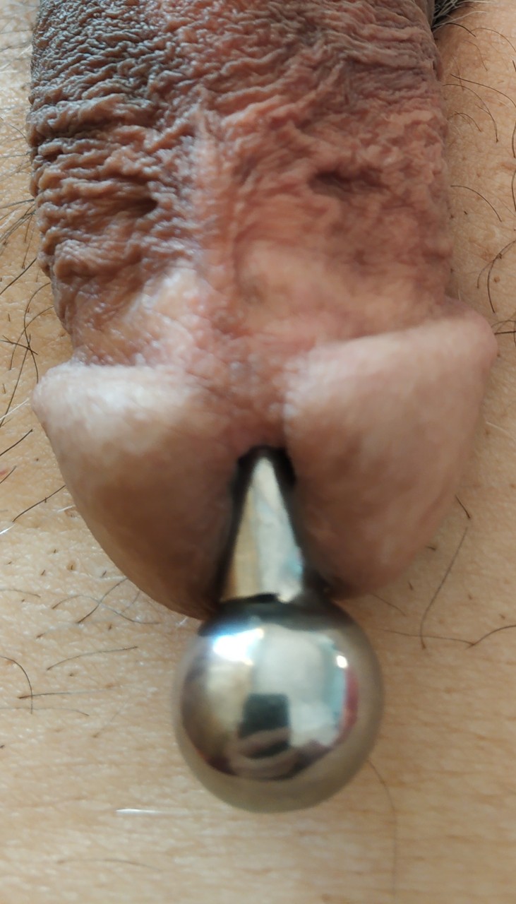 After frenulum resection