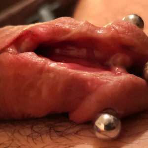 subincision extension healing 2022