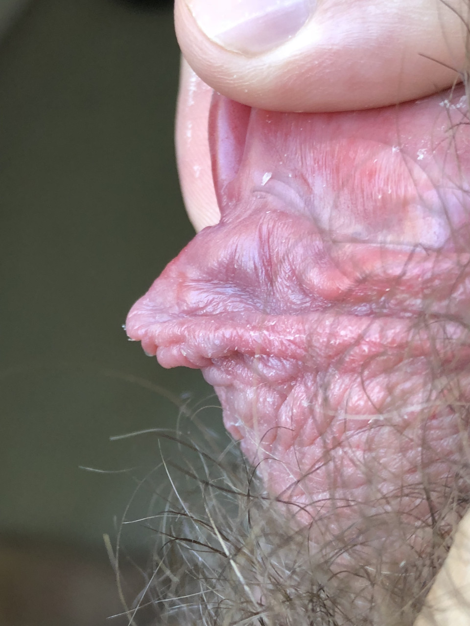 I would like to snip this bit, which has the ligament from the frenun attachment to glans