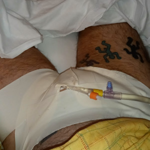 Waking up after nullo surgery 