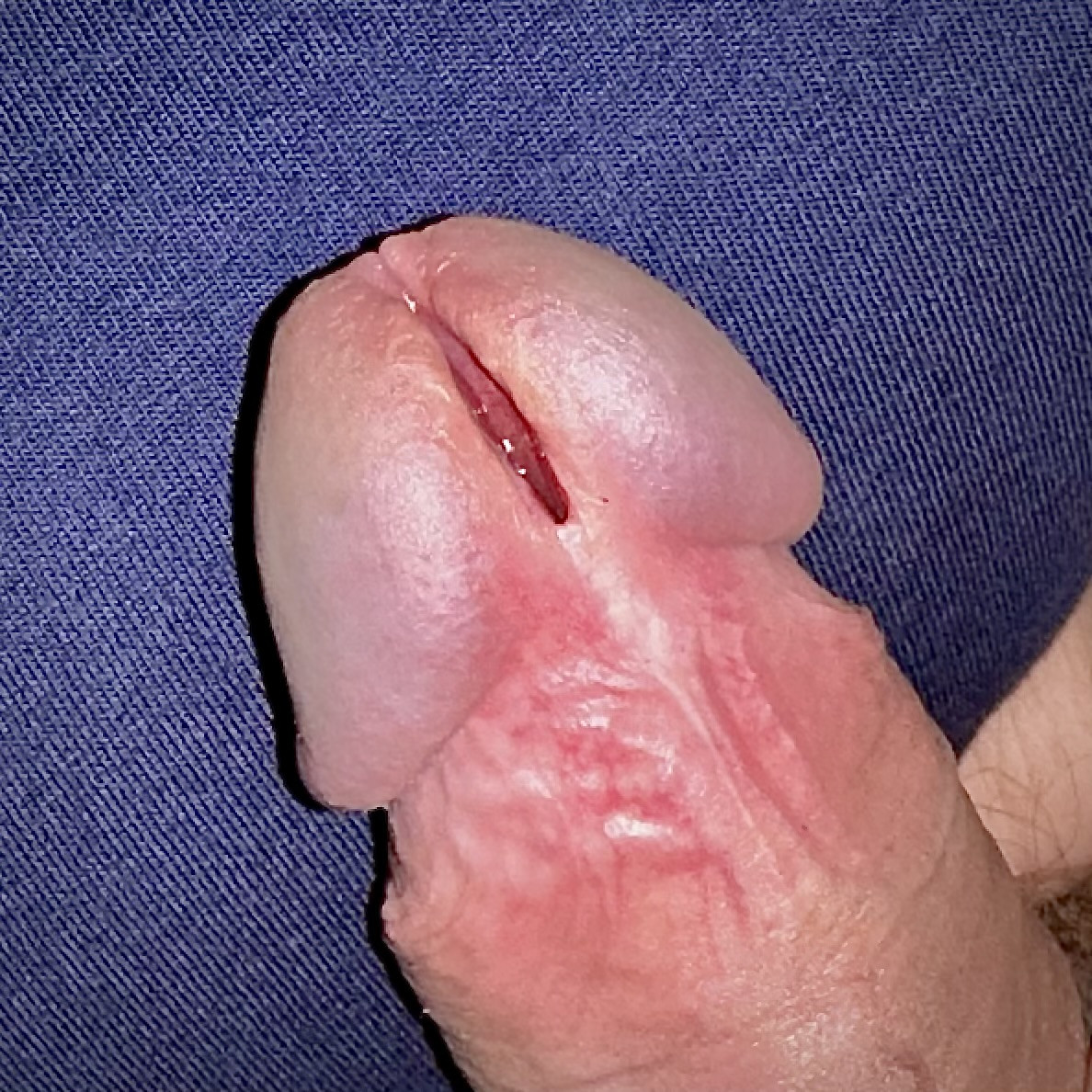 Natural gape