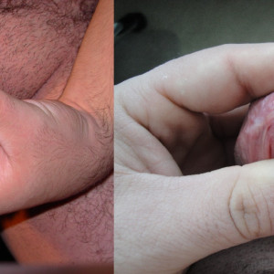 Meatotomy Progress