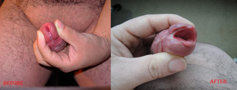 Meatotomy Progress