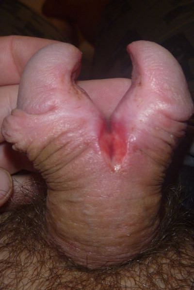 the second day after the incision