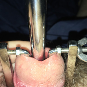 Before meato, using tapered sound with stretcher 