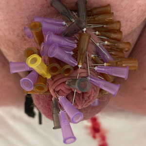 40 Needles out side in Penis 