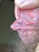 I would like to snip this bit, which has the ligament from the frenun attachment to glans