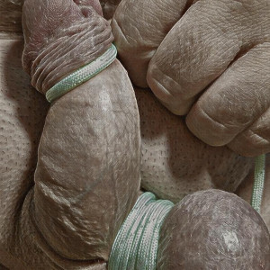 One testicle & Meatotomy 