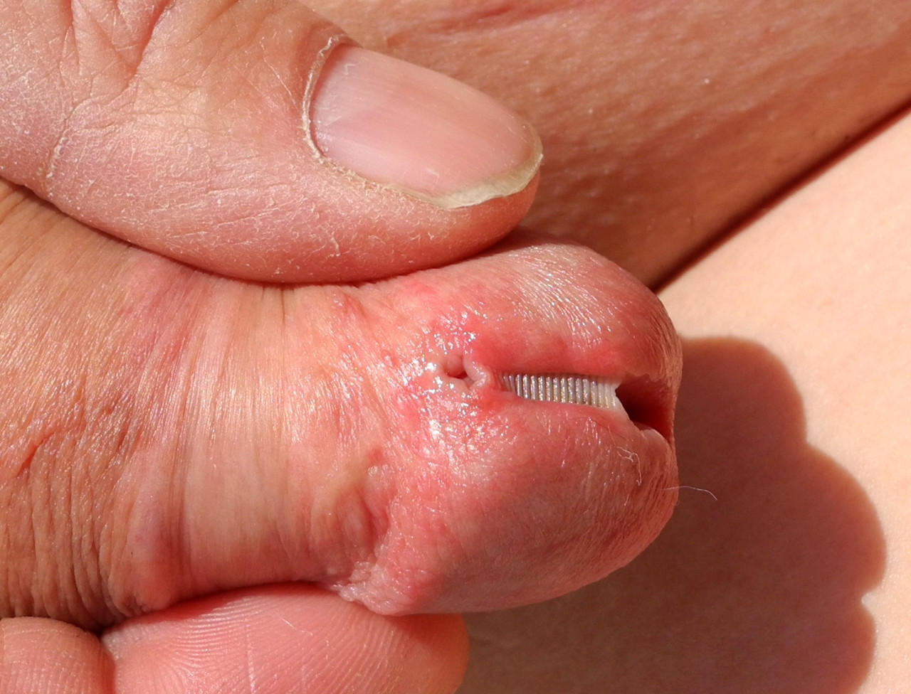 clamped