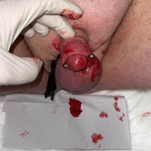 Blood penis