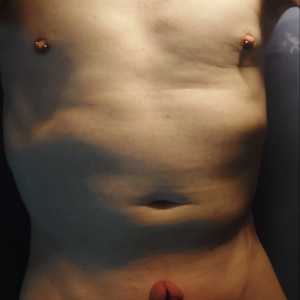 Verlängerung der Subincision ?