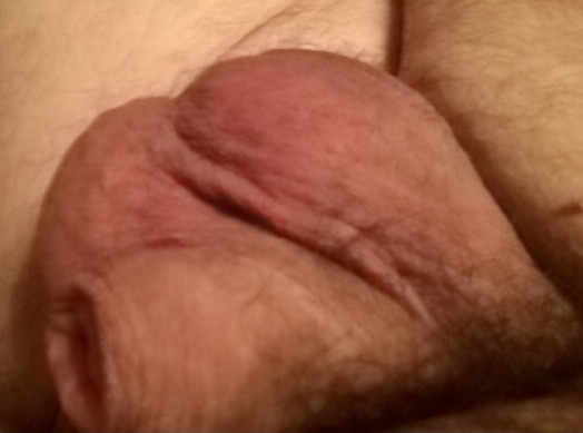 Before Injections 