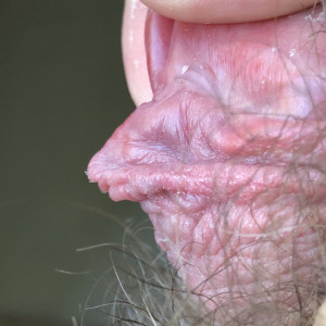 I would like to snip this bit, which has the ligament from the frenun attachment to glans