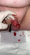 Blood penis