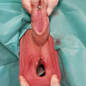 freshly expanded transscrotal