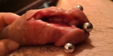 subincision extension healing 2022