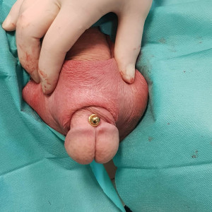 50 mm Transscrotal 