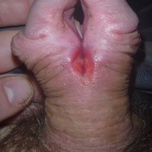 the second day after the incision