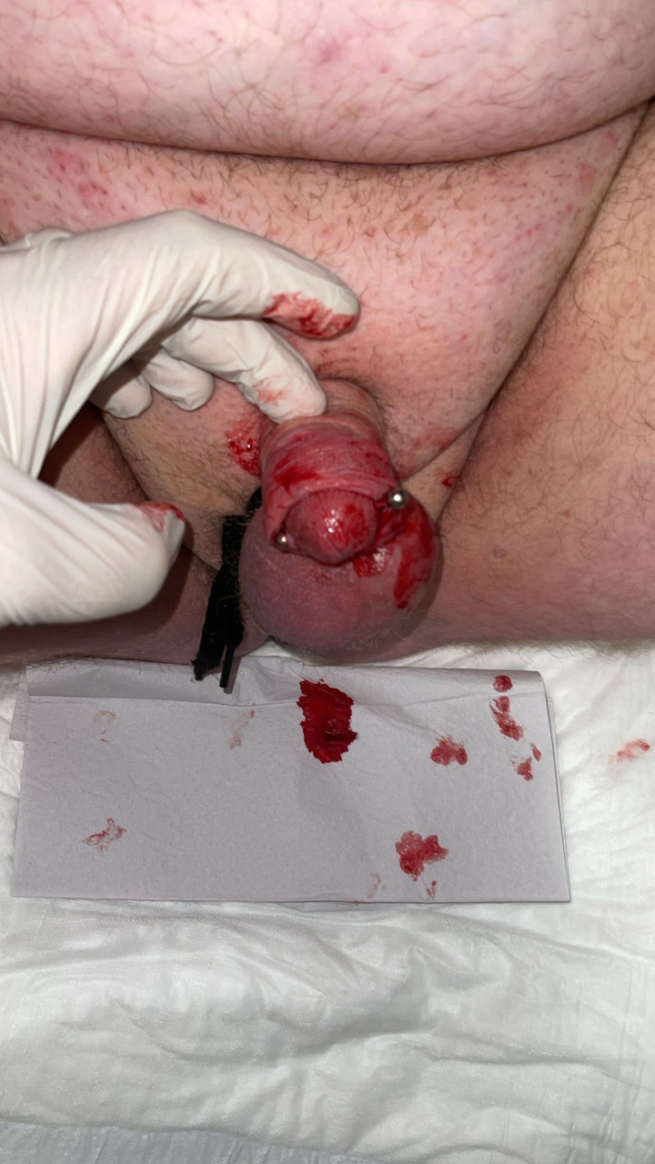 Blood penis