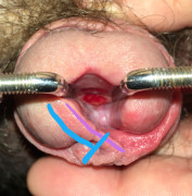 Apart from the frenun, I wasn’t fond of the puffy border of the new meatus, so plan to trim that  