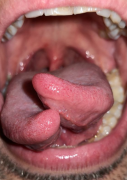 healed tongue split 2023
