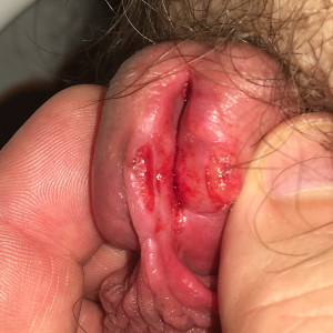 First step tying frenun