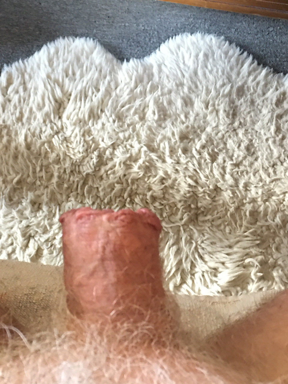 Erection, 5 weeks after glansectomy - still swollen.