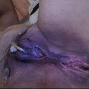 Just after surgery