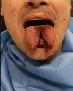 just done tongue split 2022