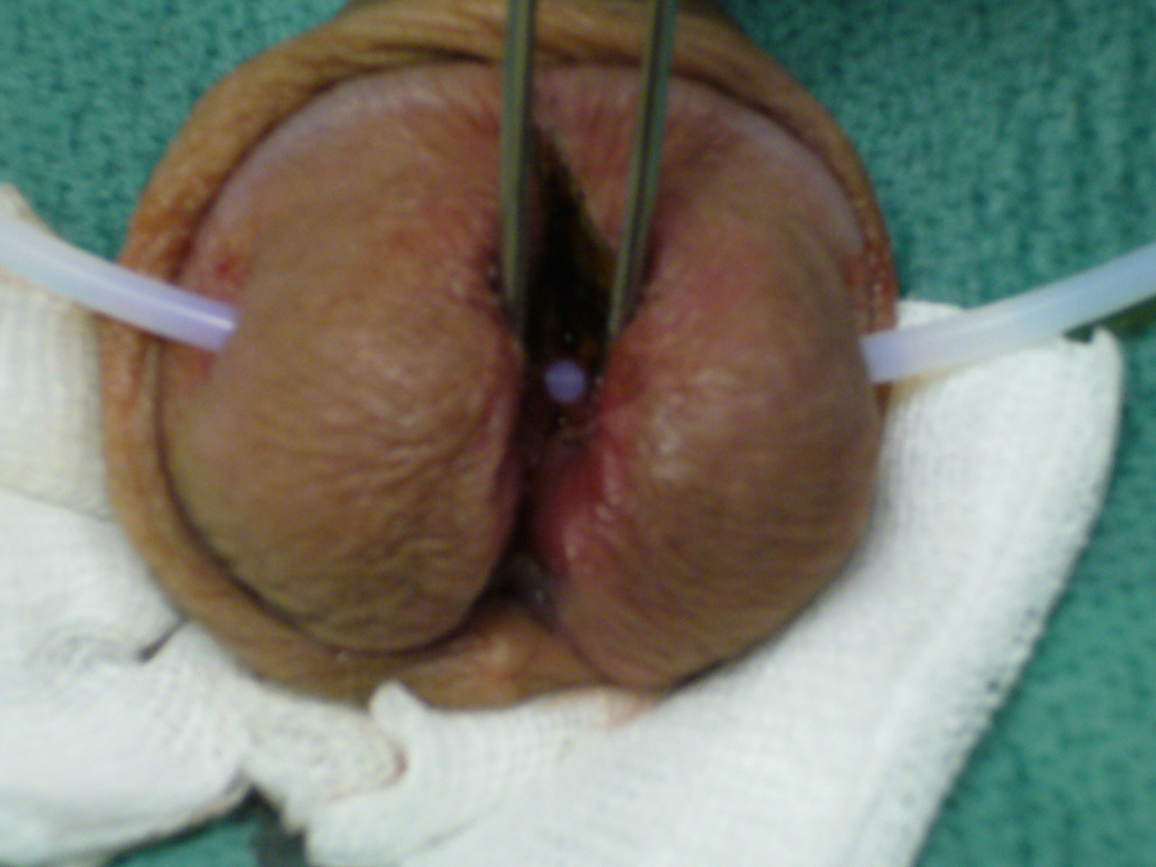 save the ampallang while splitting