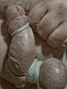 One testicle & Meatotomy 