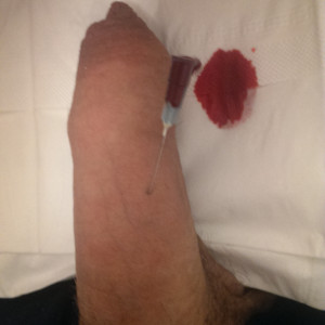 First time I pricked my shaft with a needle; eventually need help with this the next time?