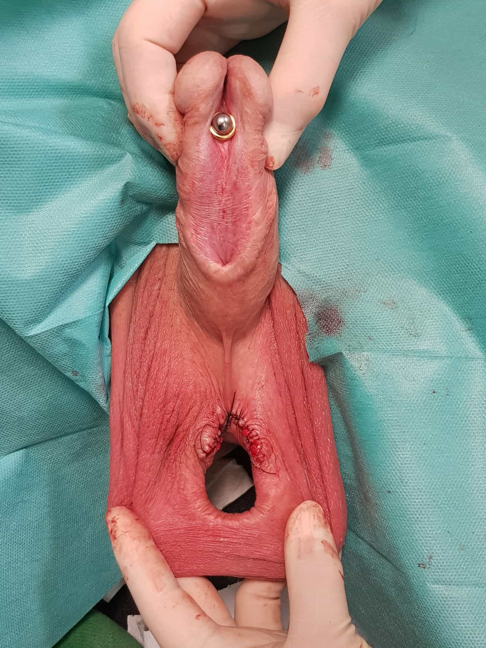 freshly expanded transscrotal