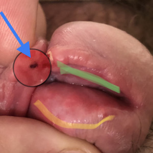 The zoomed portion shows a spot exposed after the first tie cut through. I presume it’s a ligament attaching the frenun to the glans 