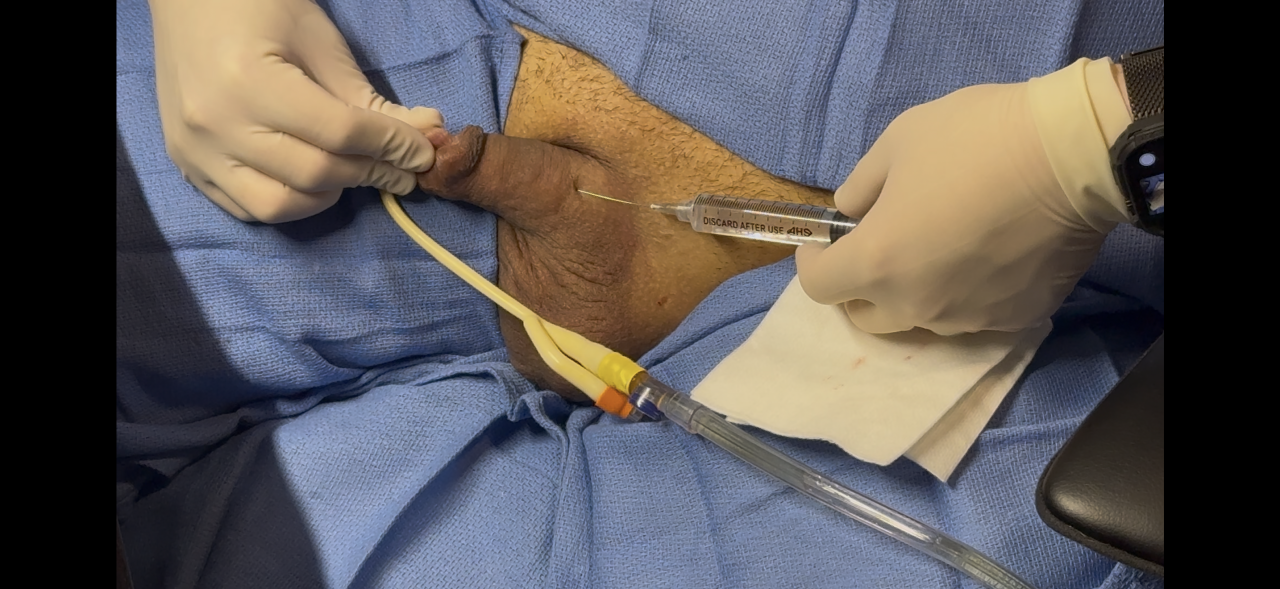 More Anesthetic Injections