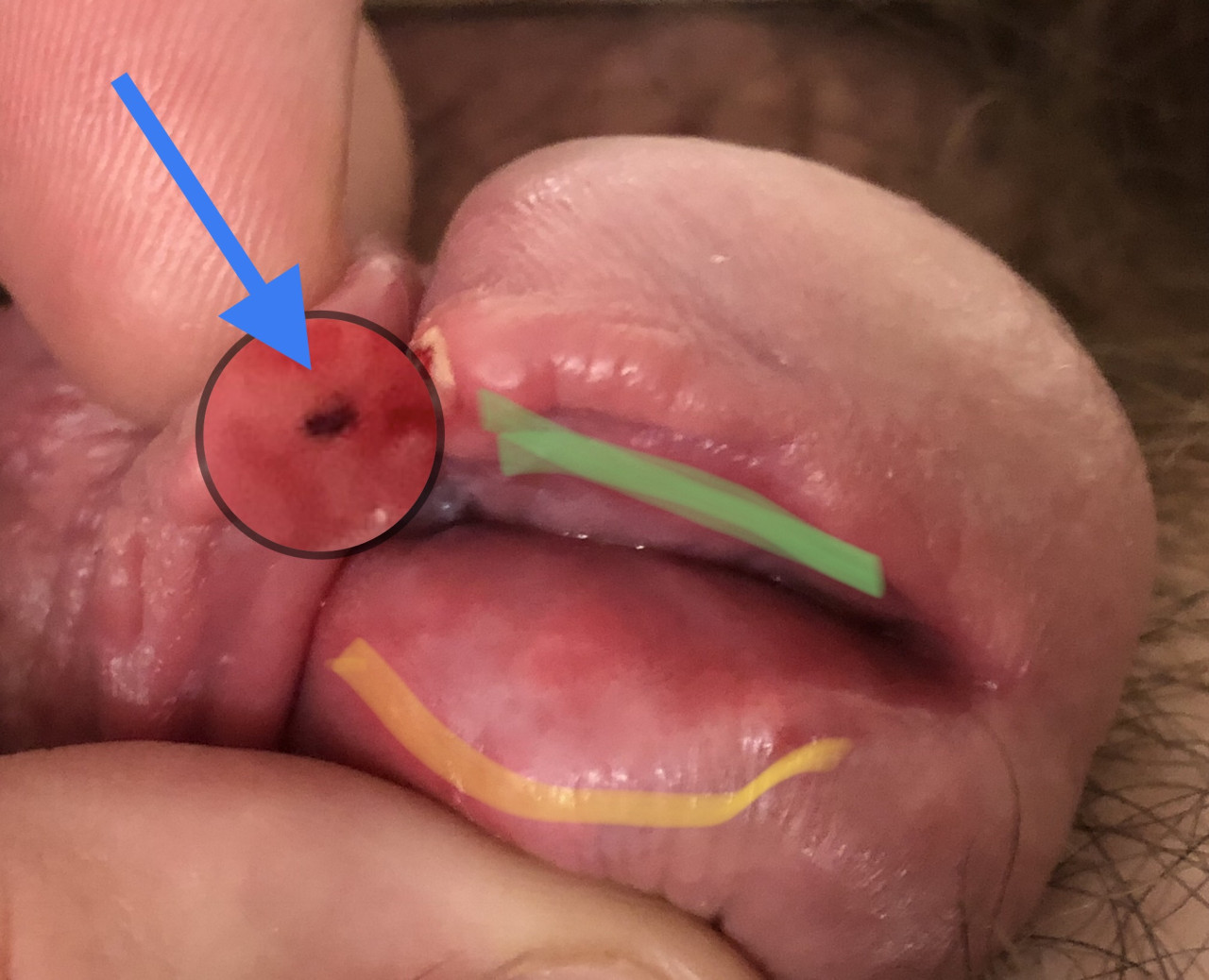 The zoomed portion shows a spot exposed after the first tie cut through. I presume it’s a ligament attaching the frenun to the glans 