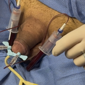 Draining Blood From Cock