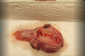 one went with me, brother into pathology. all dead and inflammated - from doc fresh furcated. Both were now big swollen - for luck me than stolen!