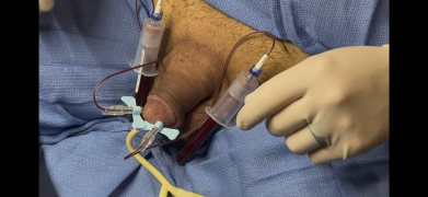 Draining Blood From Cock