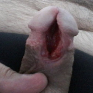 Subincision 