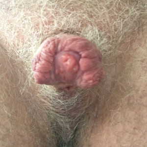 Hard stump with subincision, end view, 11 weeks after glansectomy and scrotectomy. The end still seems swollen but doesn't seem to be changing.