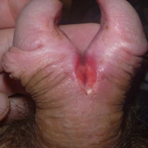 the second day after the incision