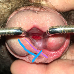 Apart from the frenun, I wasn’t fond of the puffy border of the new meatus, so plan to trim that  