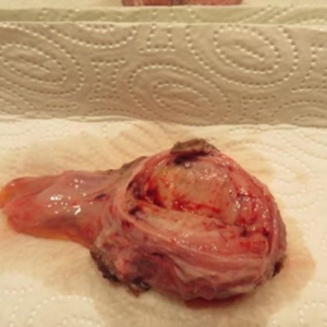 one went with me, brother into pathology. all dead and inflammated - from doc fresh furcated. Both were now big swollen - for luck me than stolen!