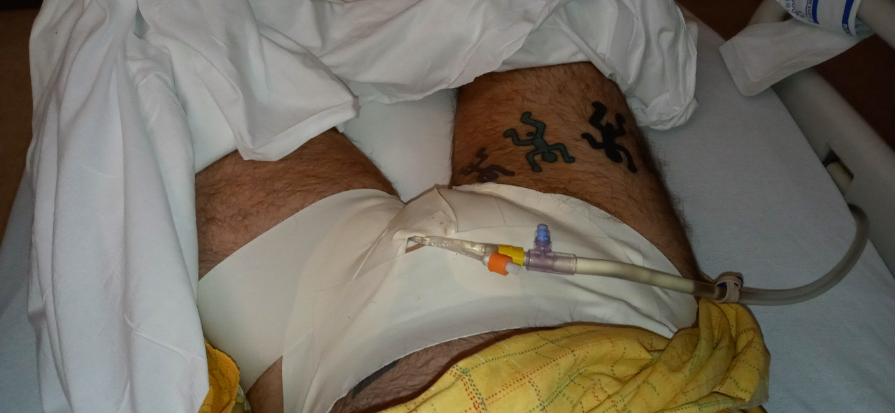 Waking up after nullo surgery 